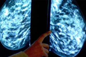 Foto: Mammogram voor een controle op borstkanker. 